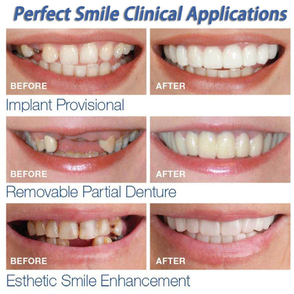 Instant Perfect Smile Dental Veneers