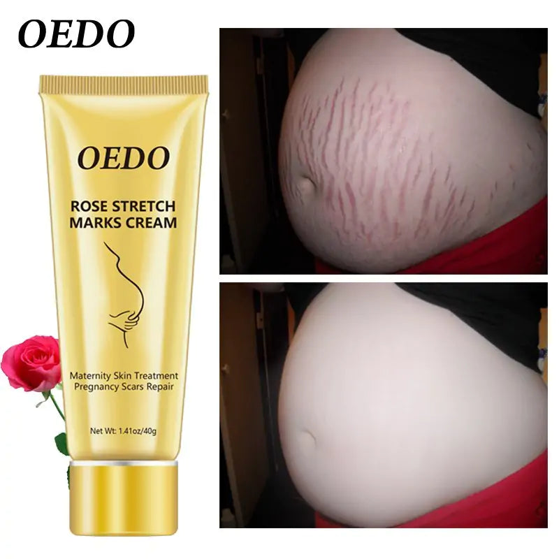 Stretch Mark Cream