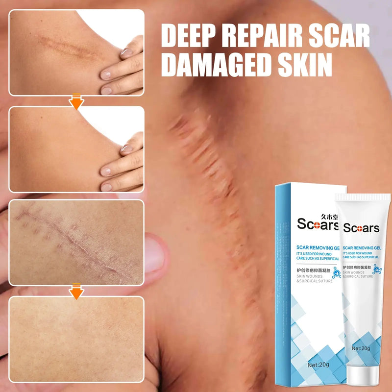 New Herbal Scar Remover Cream