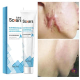 New Herbal Scar Remover Cream