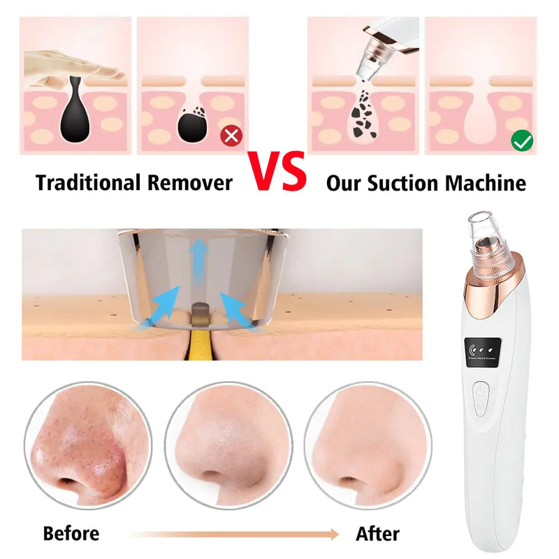 Electric Blackhead Vacuum