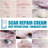 New Herbal Scar Remover Cream